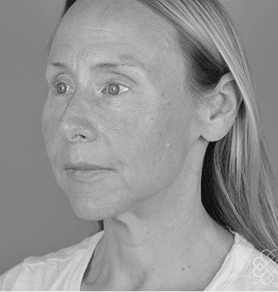 Primary Rhinoplasty
