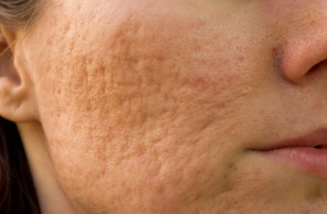 Acne scar treatment: close-up image of the cheek of a woman with acne scars