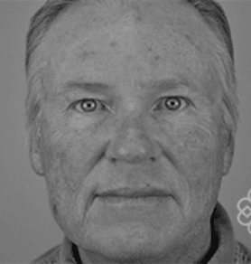 Laser Resurfacing