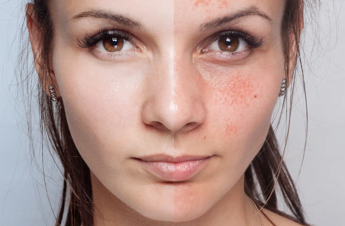 Acne Scar Treatment: woman before and after of acne treatment