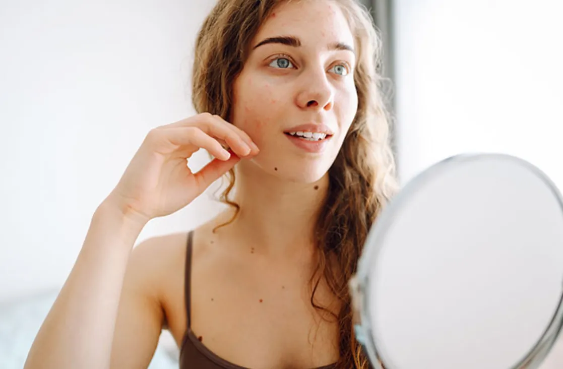 Acne Scar Treatment: woman talking and looking in the mirror