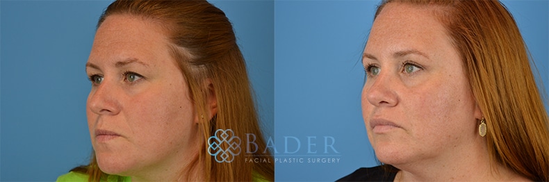 Browlift Patient 4 before and after - View 2