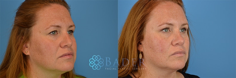 Browlift Patient 4 before and after - View 4