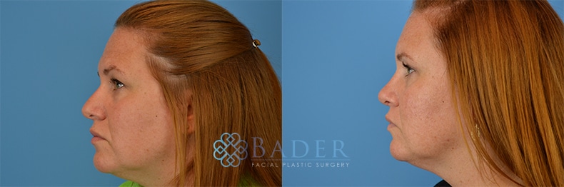 Browlift Patient 4 before and after - View 3