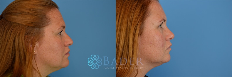 Browlift Patient 4 before and after - View 5