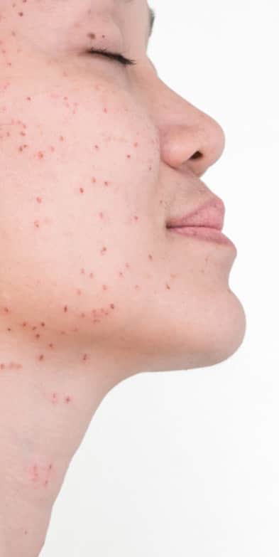 Acne Scar Treatment: Side profile of woman with acne