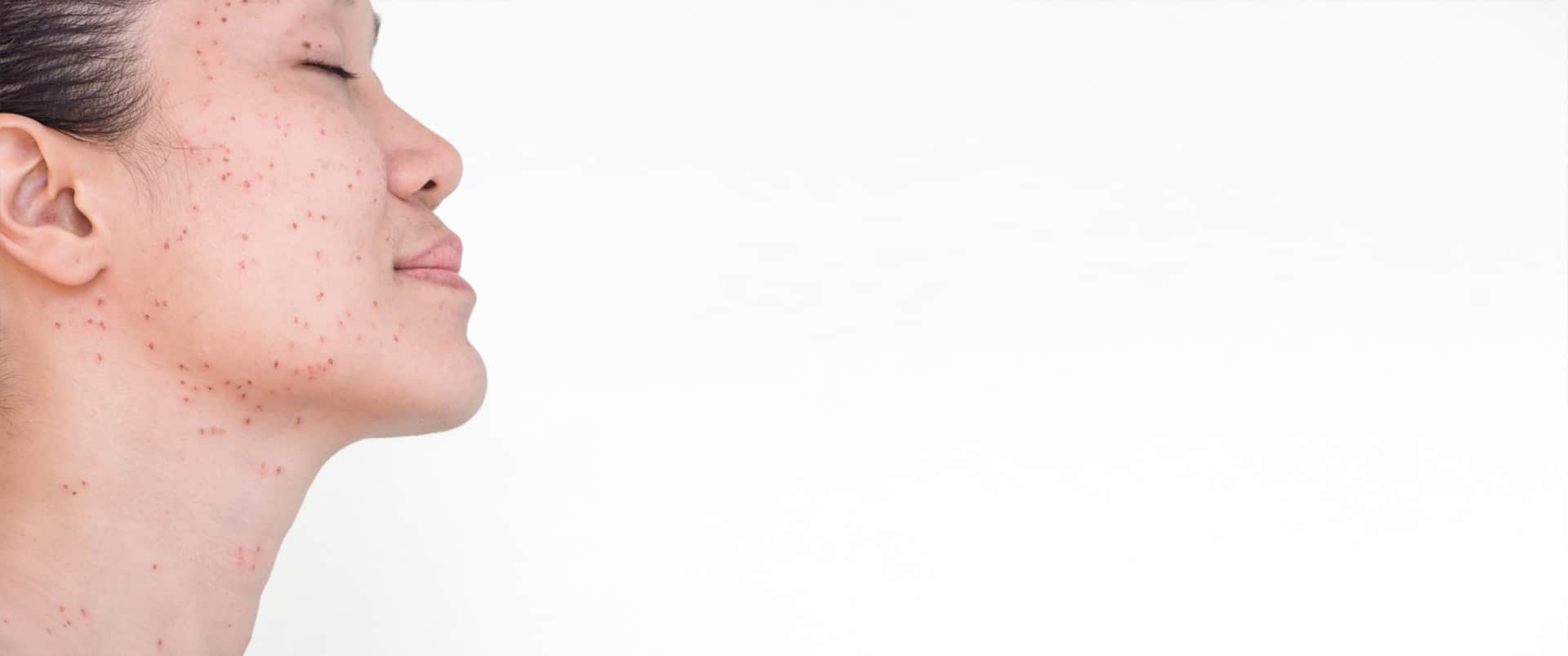 Acne Scar Treatment: Side profile of woman with acne