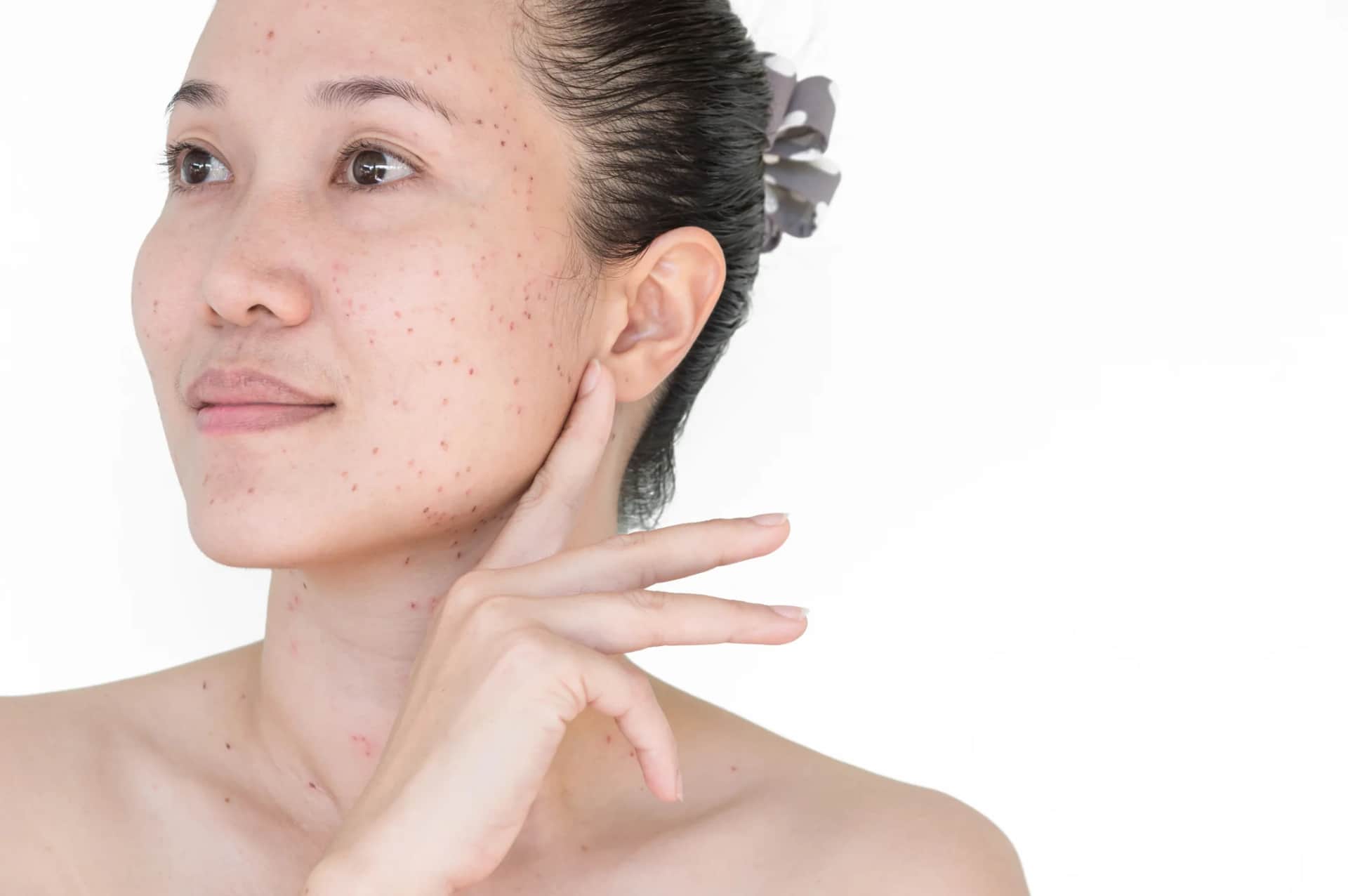 Chemical Peel: Woman with acne-prone skin before facial peel treatment