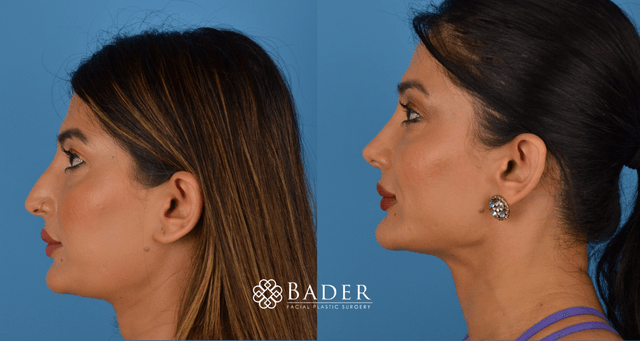 Bader Rhinoplasty Primary Rhinoplasty - Patient 2