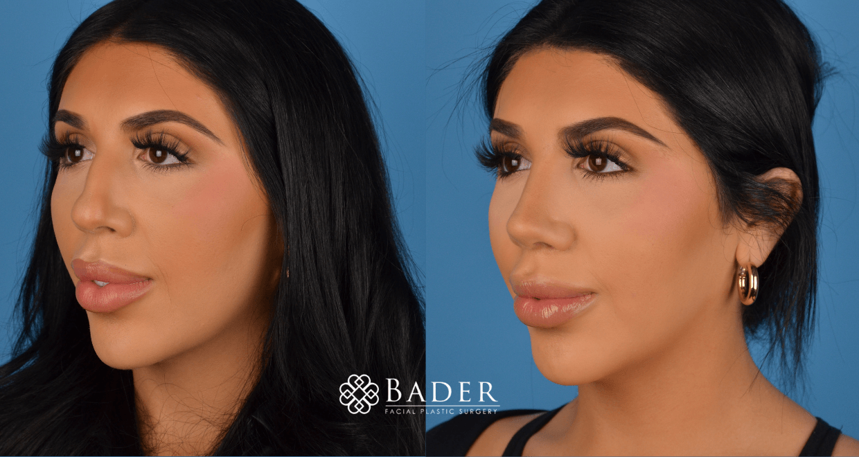 Bader Rhinoplasty Primary Rhinoplasty - Patient 28