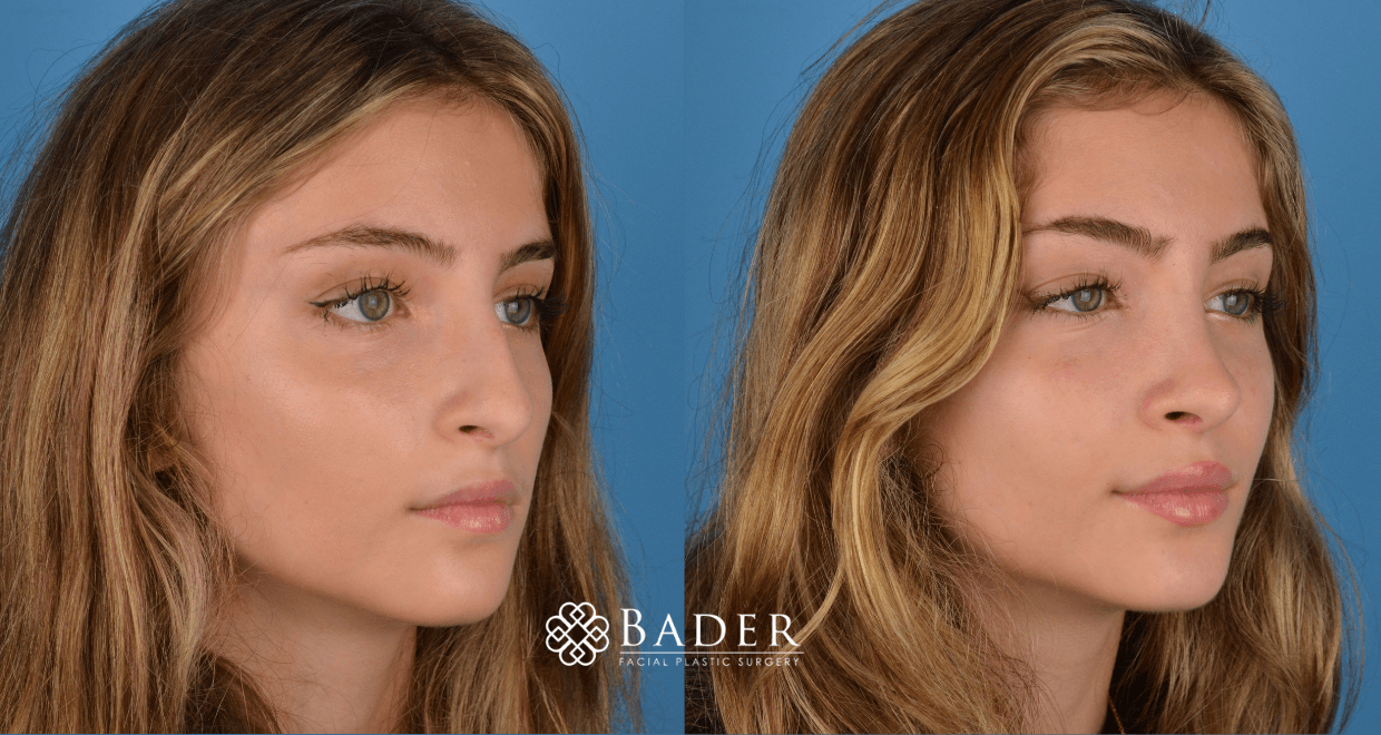 Bader Rhinoplasty Primary Rhinoplasty - Patient 34