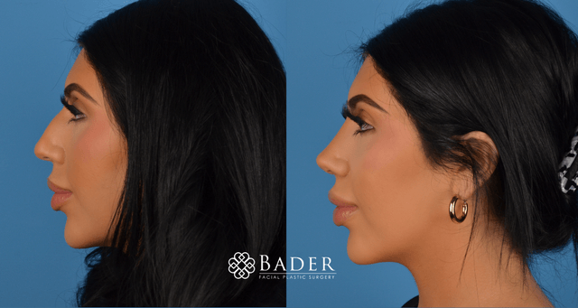 Bader Rhinoplasty Primary Rhinoplasty - Patient 2
