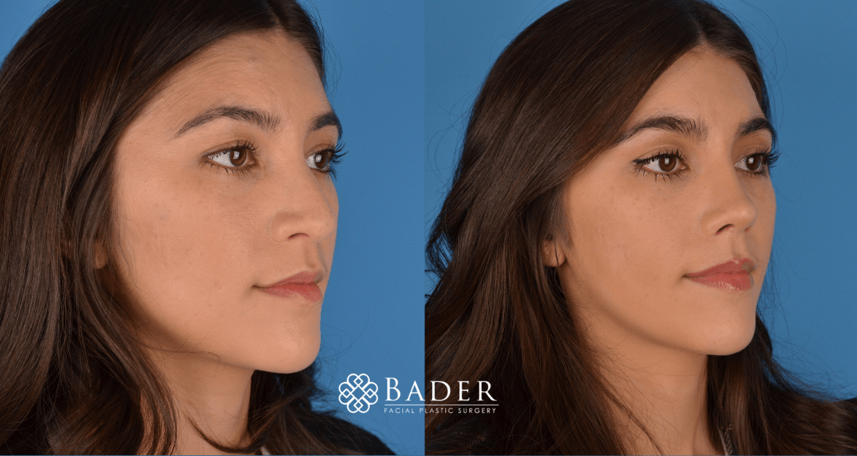 Bader Rhinoplasty Primary Rhinoplasty - Patient 48