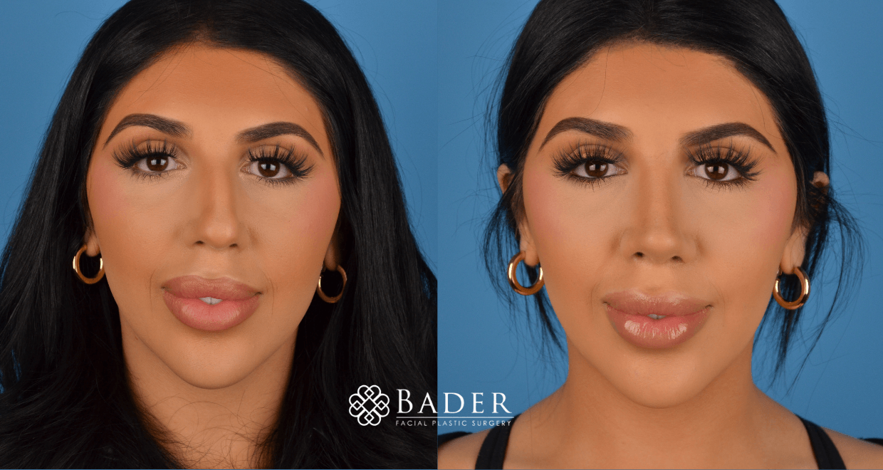 Bader Rhinoplasty Primary Rhinoplasty - Patient 28