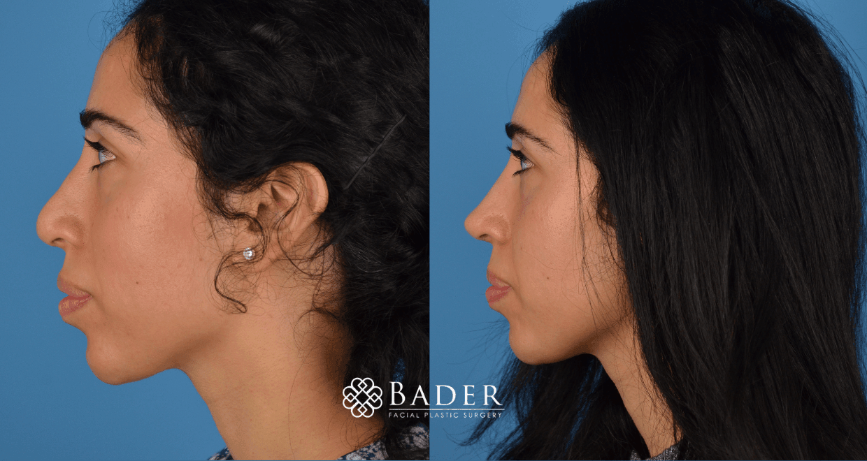 Bader Rhinoplasty Revision Rhinoplasty - Patient 7