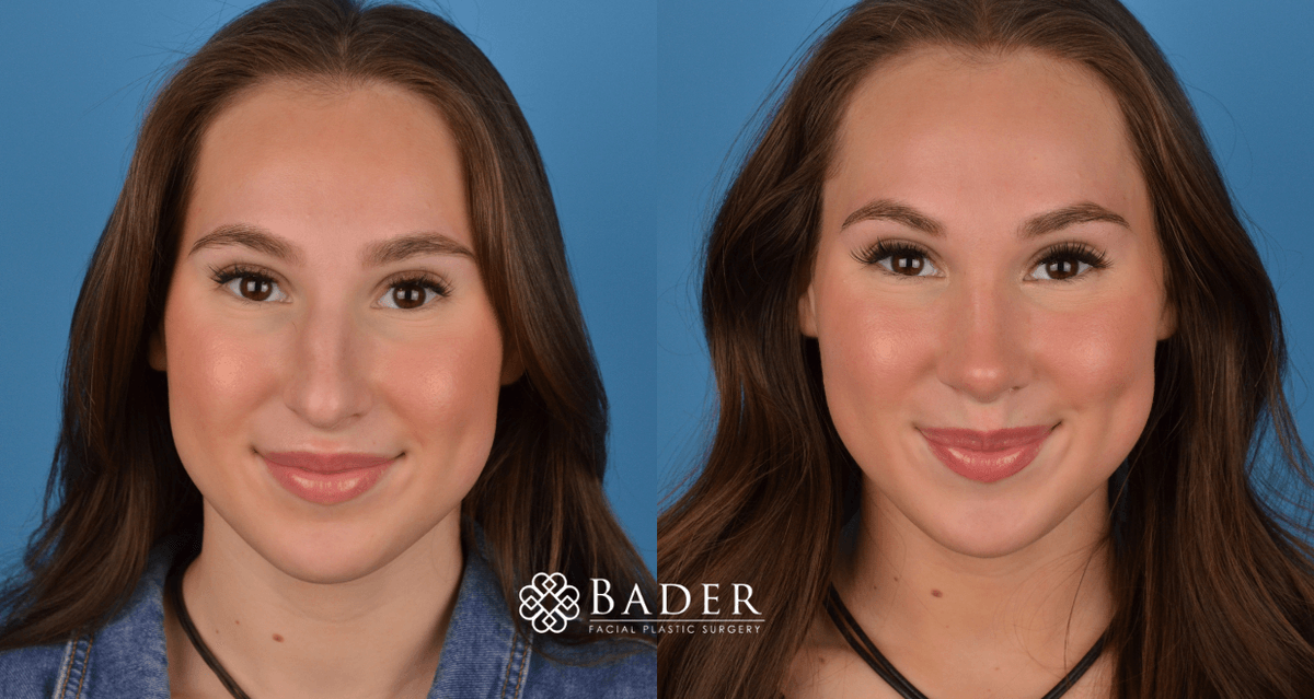 Bader Rhinoplasty Primary Rhinoplasty Before & After Photos | Bader Facial Plastics