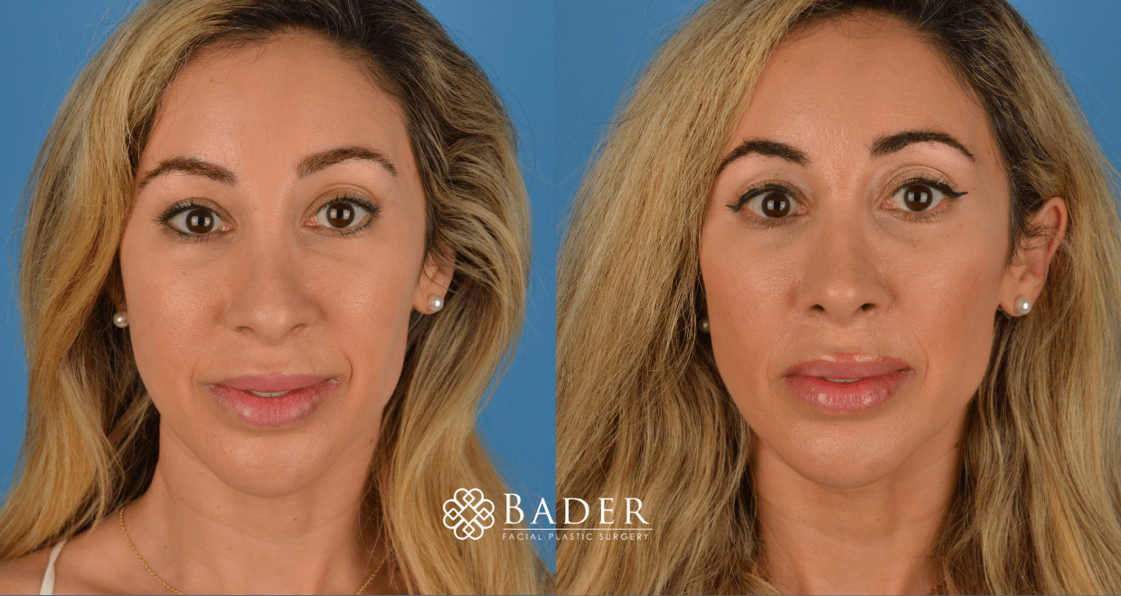 Bader Rhinoplasty Revision Rhinoplasty - Patient 1