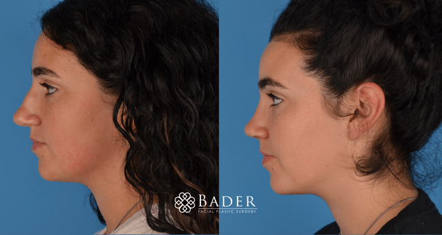 Bader Rhinoplasty Primary Rhinoplasty - Patient 2