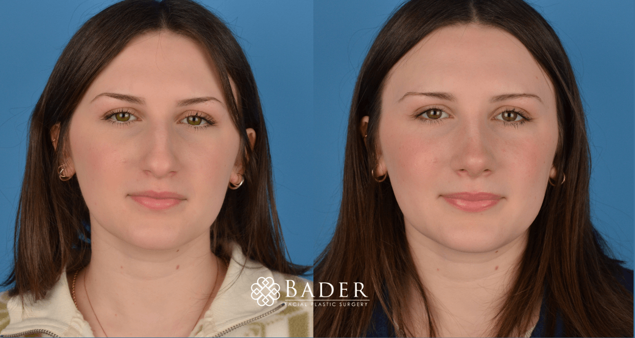 Bader Rhinoplasty Primary Rhinoplasty - Patient 5