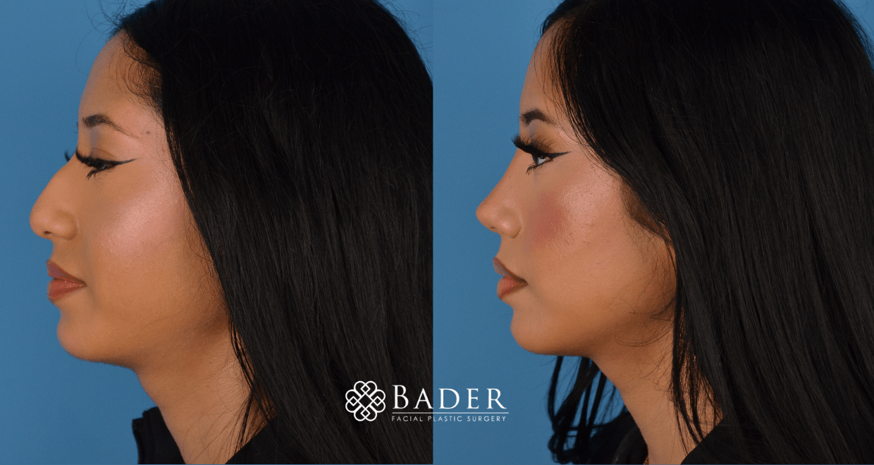 Bader Rhinoplasty Primary Rhinoplasty - Patient 31
