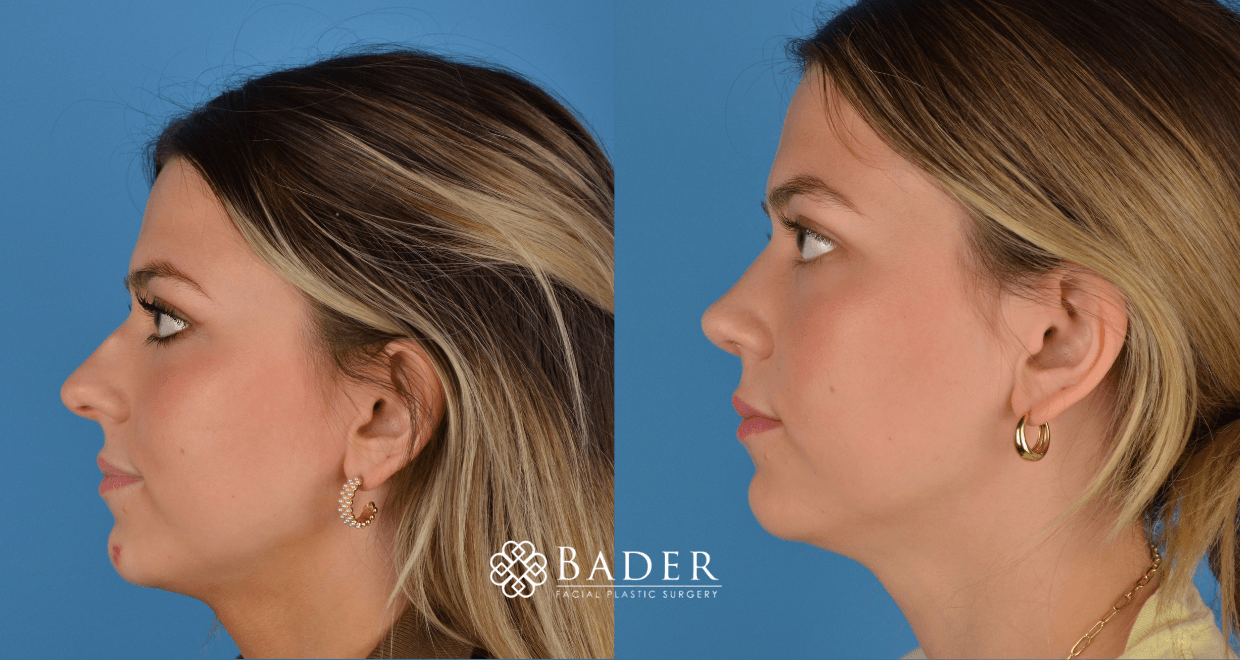 Bader Rhinoplasty Primary Rhinoplasty - Patient 53