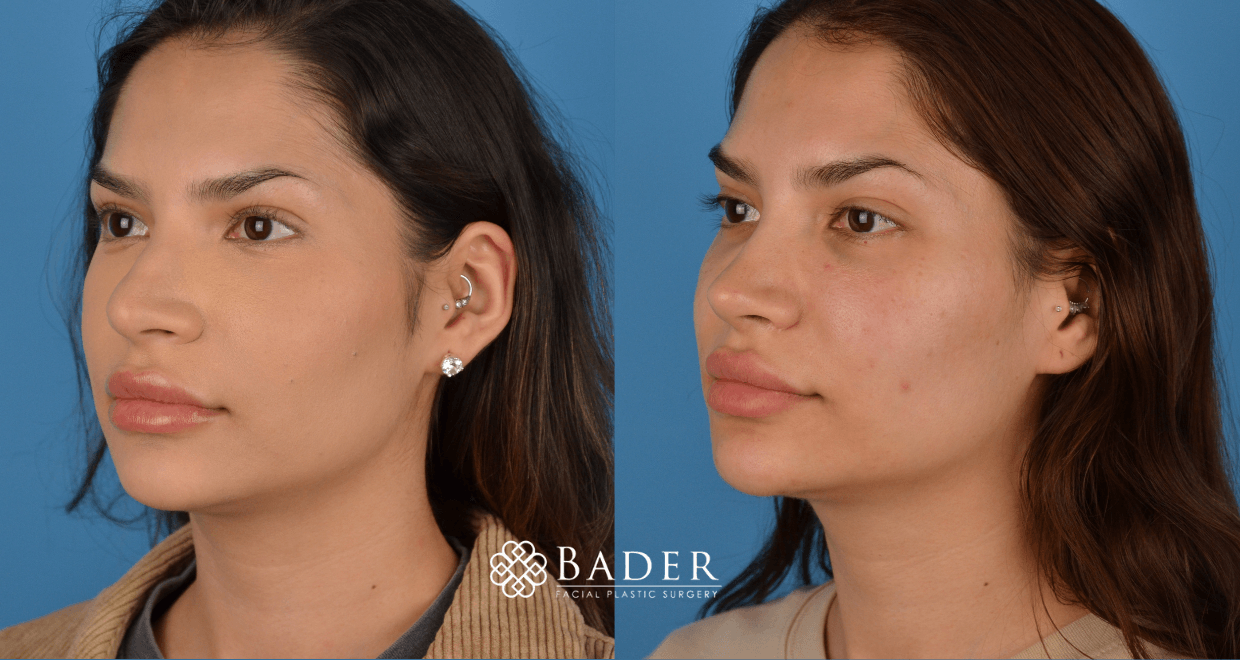 Bader Rhinoplasty Primary Rhinoplasty - Patient 36