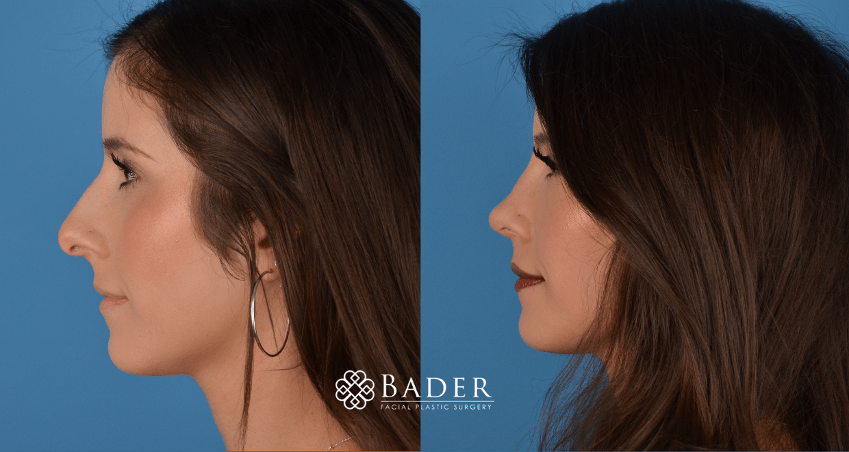 Bader Rhinoplasty Primary Rhinoplasty - Patient 42