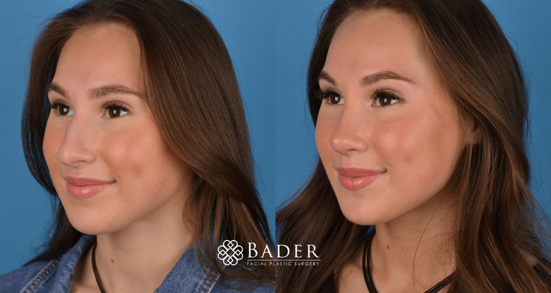 Bader Rhinoplasty Primary Rhinoplasty Before & After Photos | Bader Facial Plastics