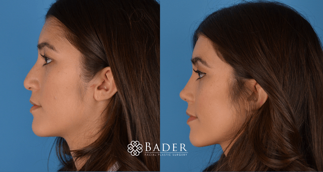 Bader Rhinoplasty Primary Rhinoplasty - Patient 2