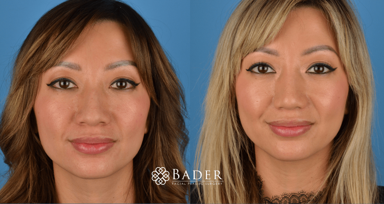 Bader Rhinoplasty Primary Rhinoplasty Before & After Photos | Bader Facial Plastics