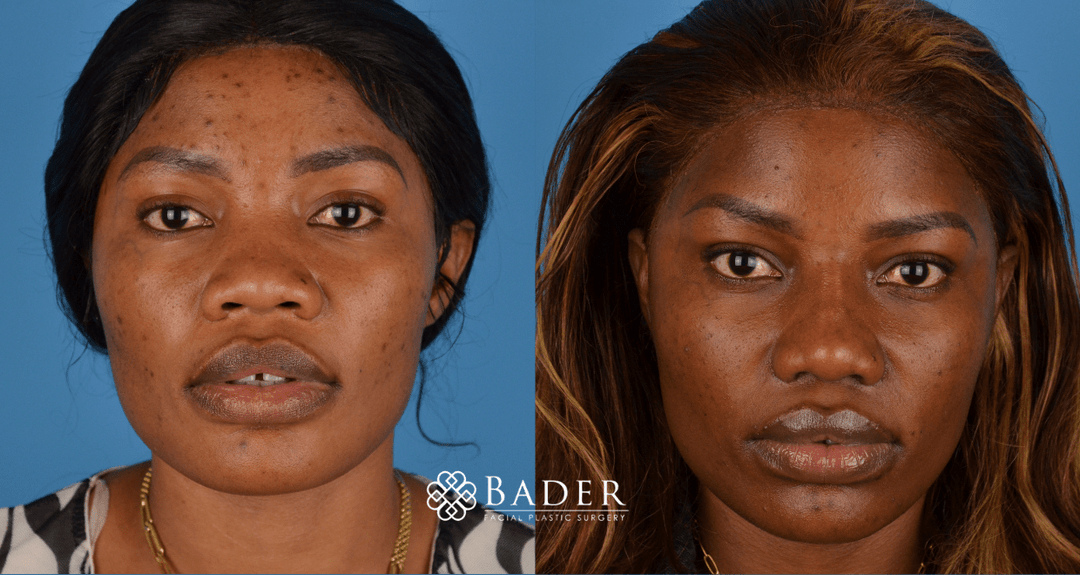 Bader Rhinoplasty Primary Rhinoplasty Before & After Photos | Bader Facial Plastics