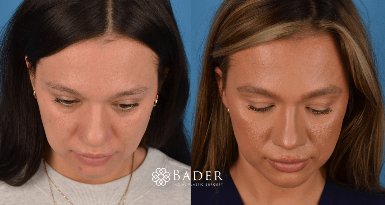 Bader Rhinoplasty Primary Rhinoplasty - Patient 27