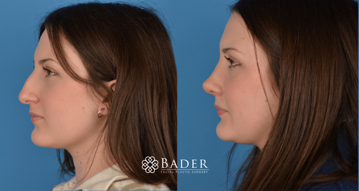 Bader Rhinoplasty Primary Rhinoplasty - Patient 5