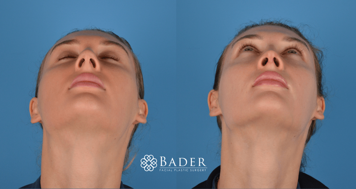 Bader Rhinoplasty Primary Rhinoplasty - Patient 32
