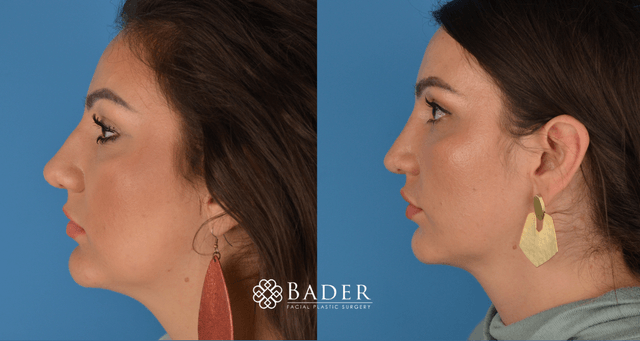 Bader Rhinoplasty Primary Rhinoplasty - Patient 2