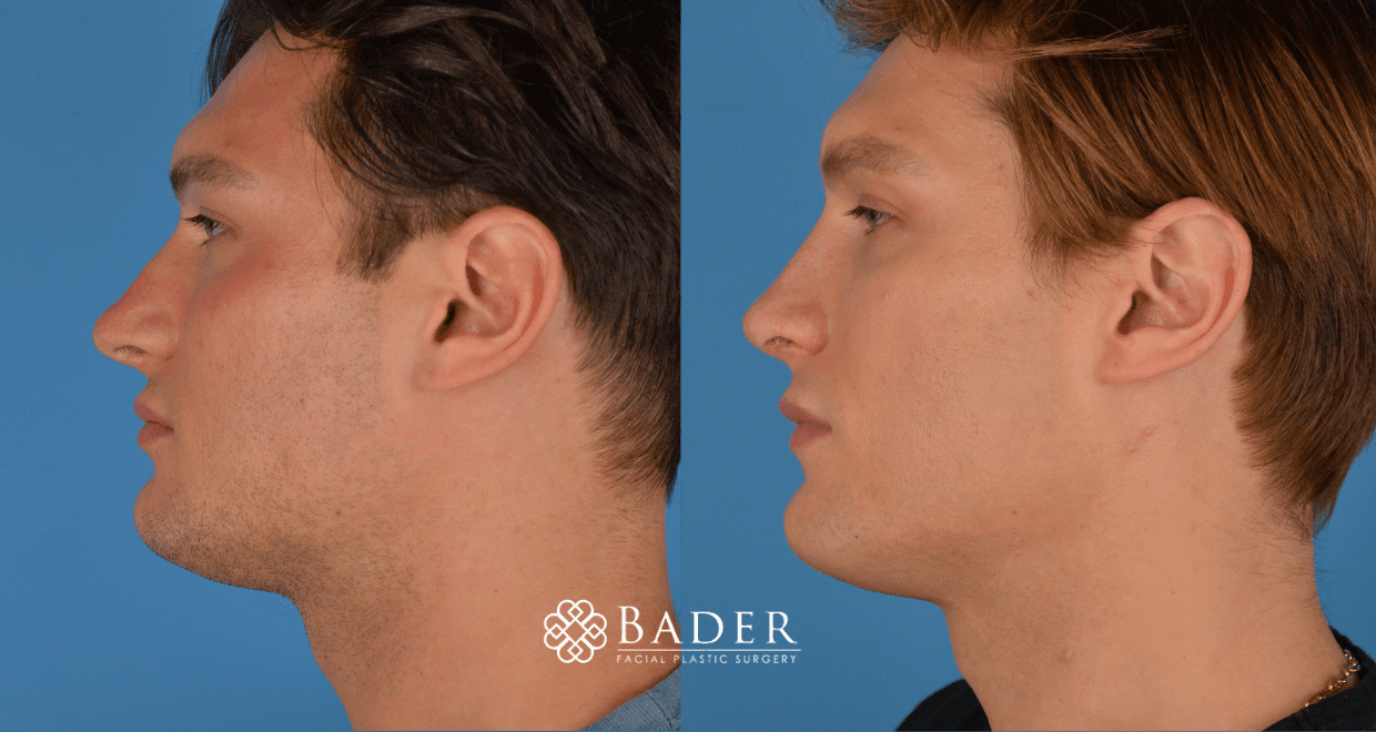 Bader Rhinoplasty Revision Rhinoplasty - Patient 6