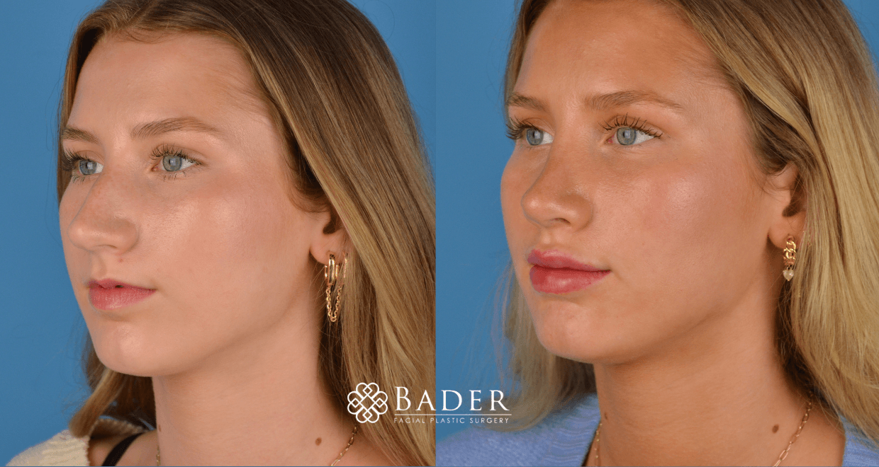 Bader Rhinoplasty Primary Rhinoplasty - Patient 41