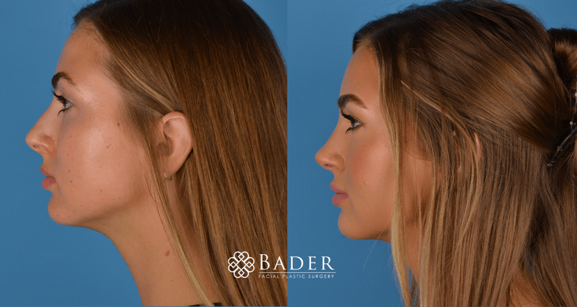 Bader Rhinoplasty Primary Rhinoplasty Before & After Photos | Bader Facial Plastics