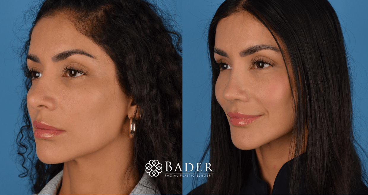 Bader Rhinoplasty Revision Rhinoplasty - Patient 5