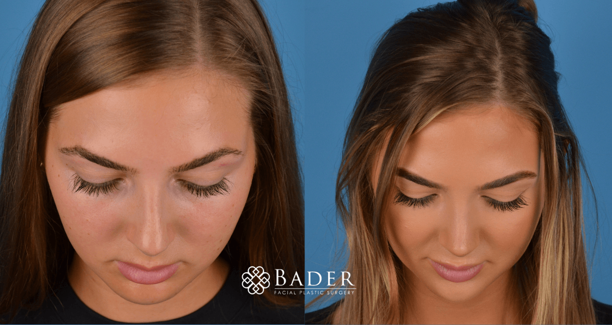 Bader Rhinoplasty Primary Rhinoplasty - Patient 2