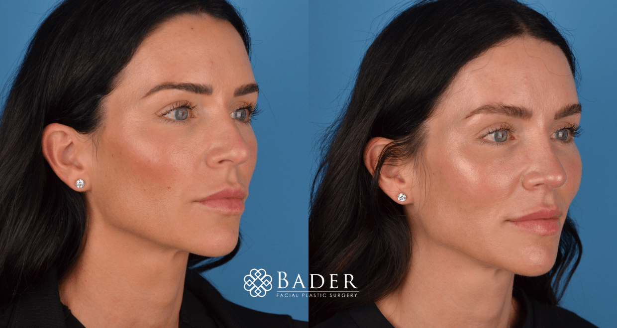 Bader Rhinoplasty Primary Rhinoplasty - Patient 14