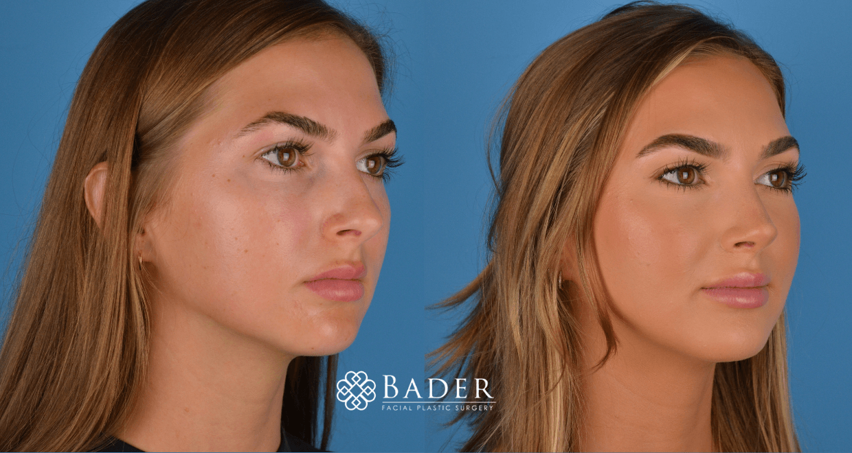 Bader Rhinoplasty Primary Rhinoplasty - Patient 2