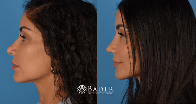 Bader Rhinoplasty Revision Rhinoplasty Patient 14