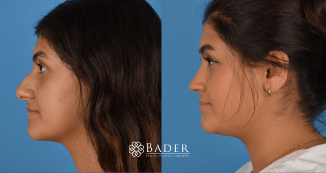 Bader Rhinoplasty Primary Rhinoplasty - Patient 2