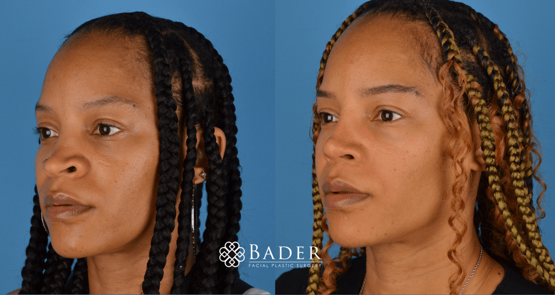Bader Rhinoplasty Primary Rhinoplasty Before & After Photos | Bader Facial Plastics