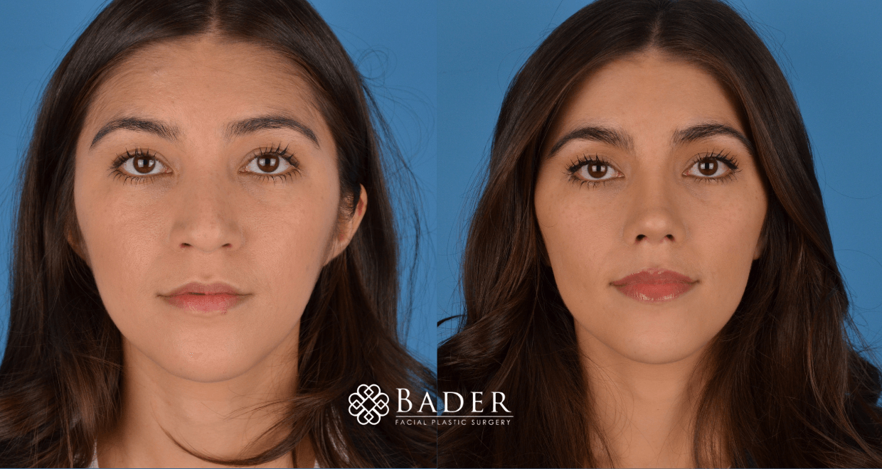 Bader Rhinoplasty Primary Rhinoplasty - Patient 48