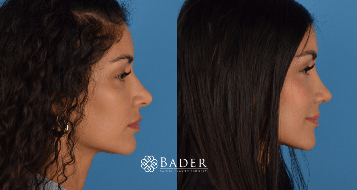 Bader Rhinoplasty Revision Rhinoplasty - Patient 5