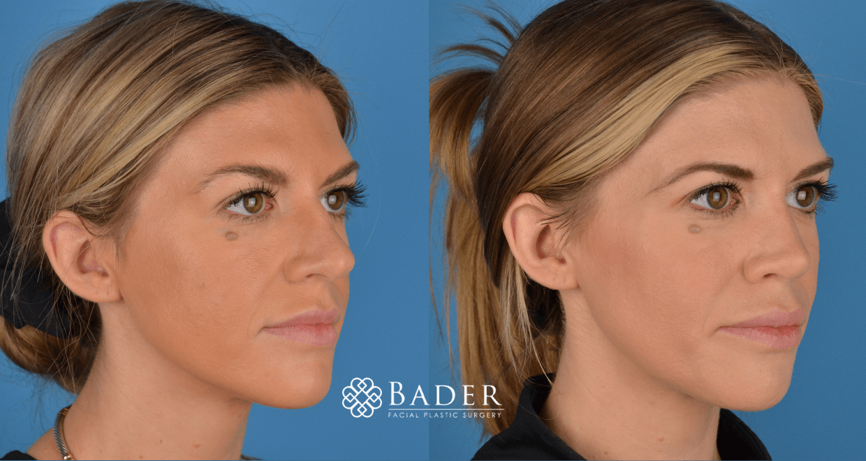 Bader Rhinoplasty Primary Rhinoplasty - Patient 52