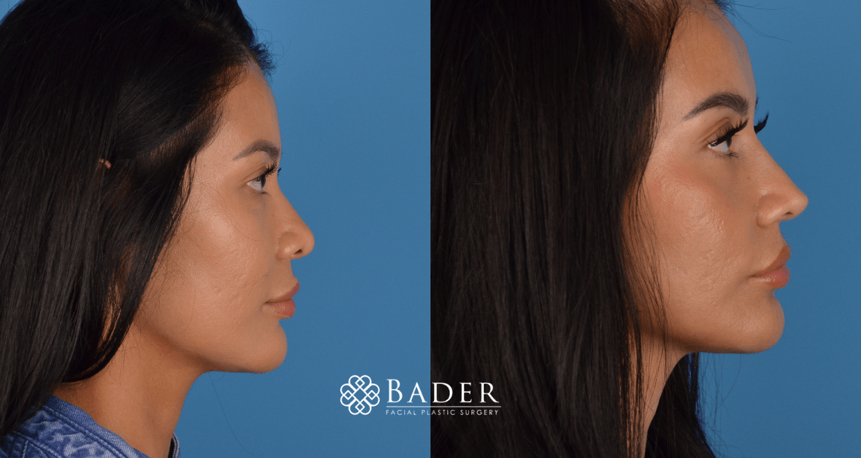 Bader Rhinoplasty Primary Rhinoplasty - Patient 12