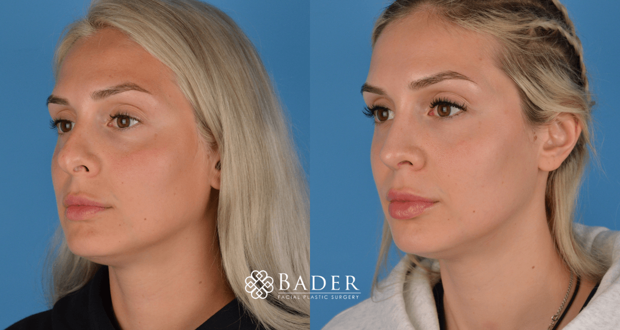 Bader Rhinoplasty Primary Rhinoplasty - Patient 10